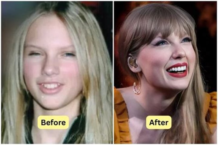 Does Taylor Swift Have Veneers?