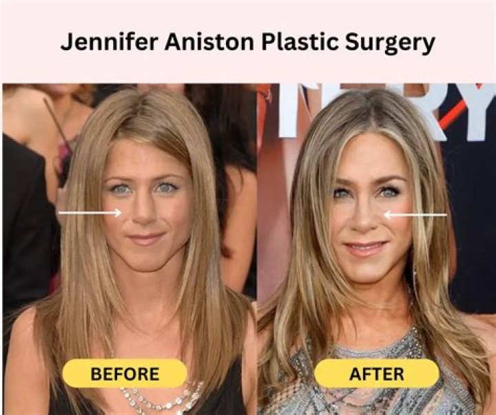 Has Jennifer Aniston Had Plastic Surgery?